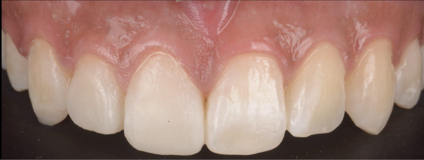 歯ぎしりで犬歯や前歯が削れてしまった方へ ― マウスピースだけではない包括的治療