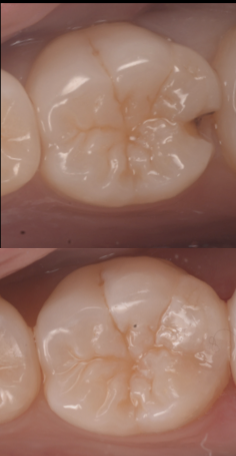 池袋で歯が割れた・欠けた時の応急処置と治療法｜グランドメゾンデンタルクリニック