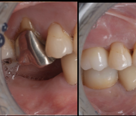 【池袋】この歯、残せる？──抜歯と診断された歯を精密治療で守る選択