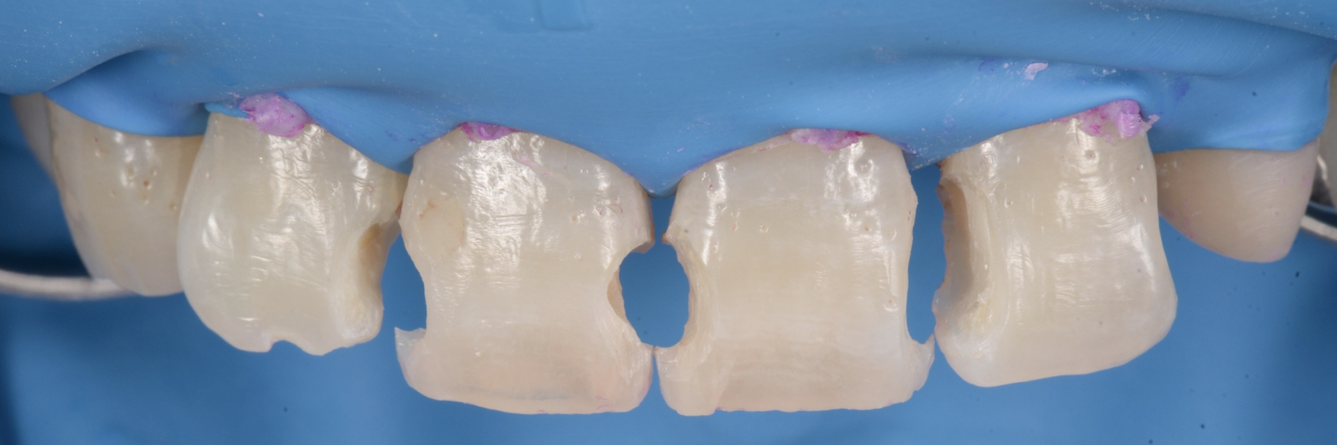 【担当医:荻原太郎】ダイレクトボンディング