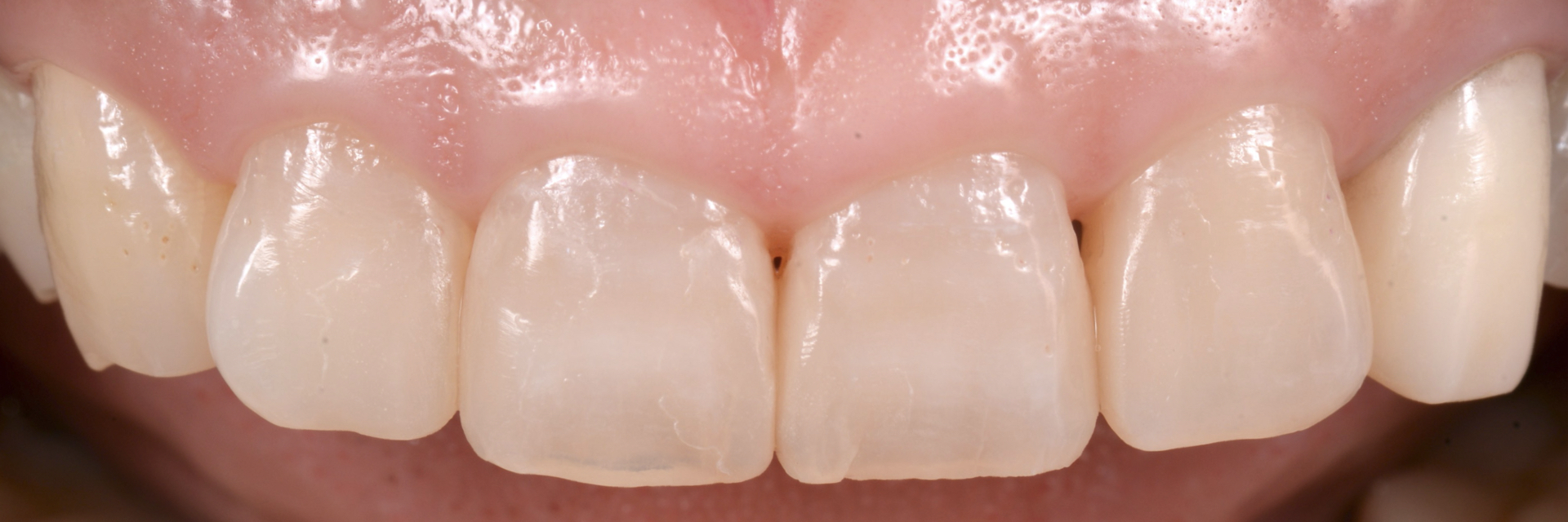 【担当医:荻原太郎】ダイレクトボンディング