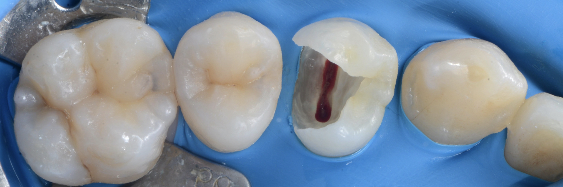 【担当医:荻原太郎】歯の神経を残す治療