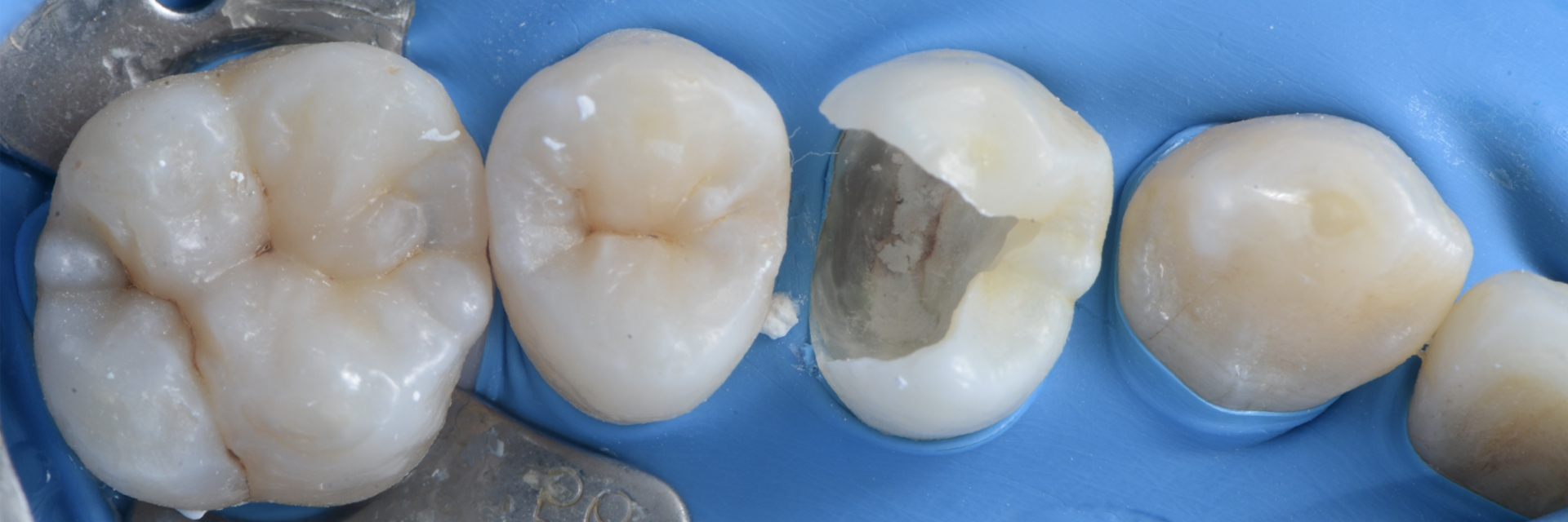 【担当医:荻原太郎】歯の神経を残す治療