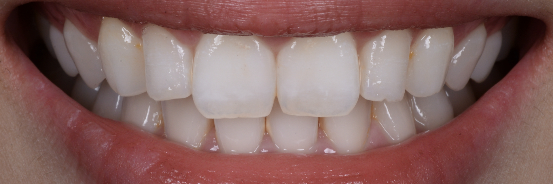 【担当医:荻原太郎】ガミースマイルを改善する（歯肉整形）