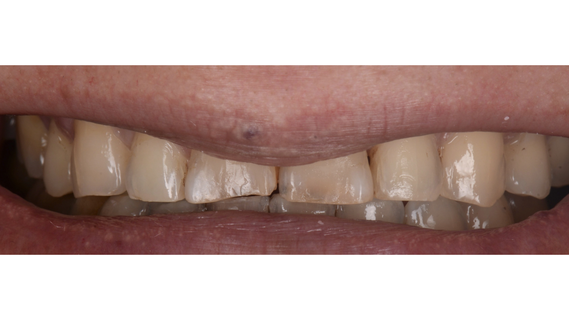 【担当医:荻原太郎】矯正治療によって生じた審美障害に対してラミネートベニヤを用いて改善したケース