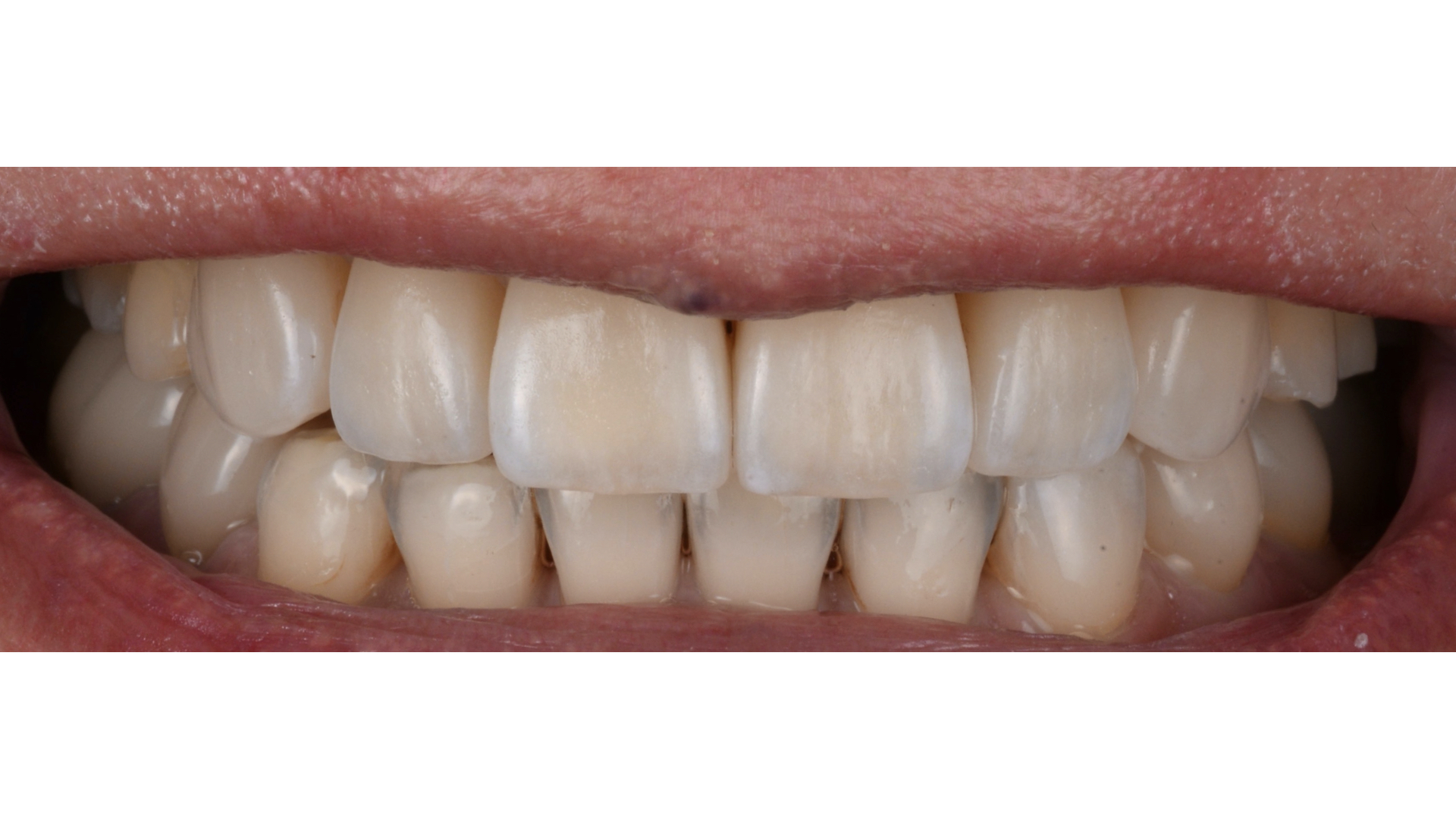 【担当医:荻原太郎】矯正治療によって生じた審美障害に対してラミネートベニヤを用いて改善したケース