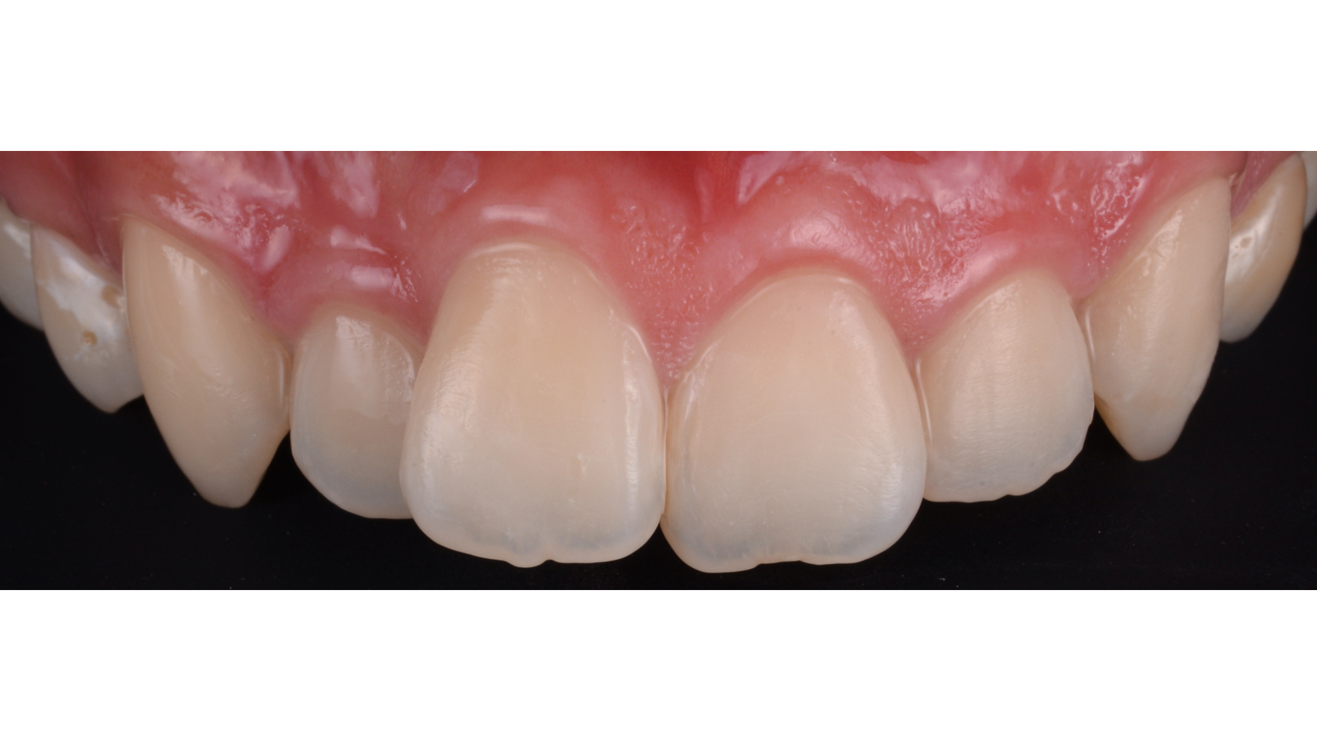 【担当医:荻原太郎】黒くなった前歯をダイレクトボンディングで修復したケース