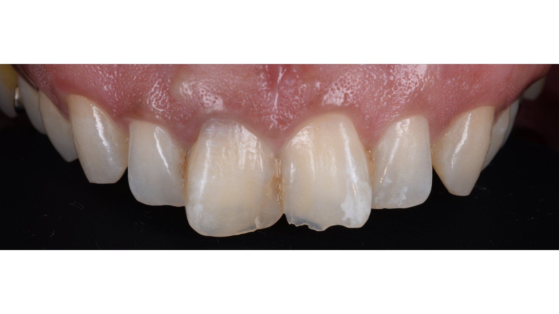 【担当医:荻原太郎】出っ歯の患者様のセラミック治療