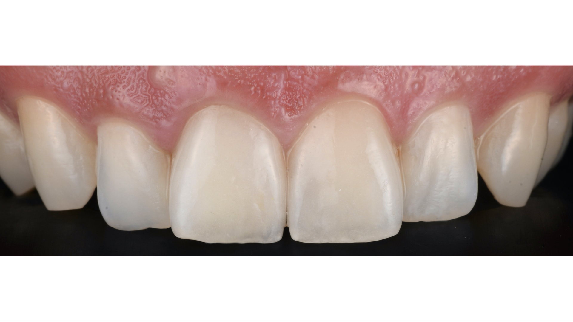 【担当医:荻原太郎】出っ歯の患者様のセラミック治療