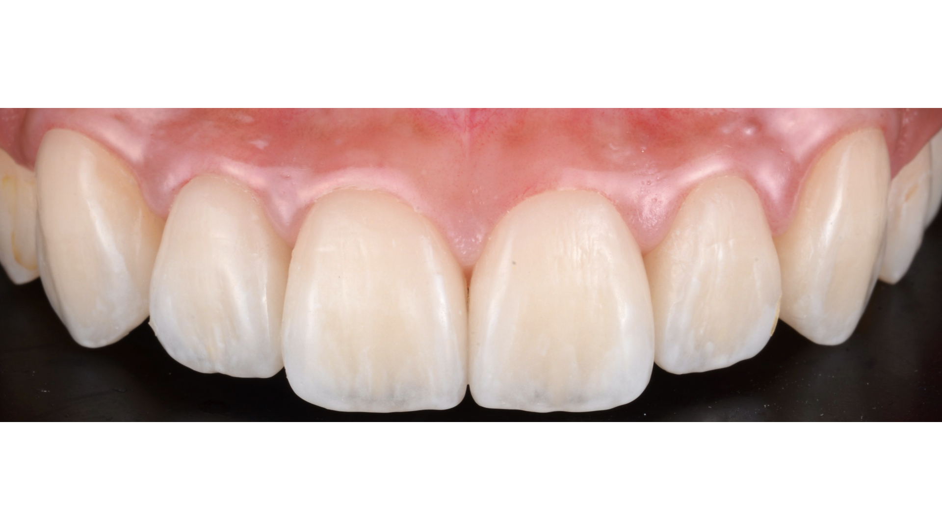 【担当医:荻原太郎】すきっ歯　前歯の審美治療