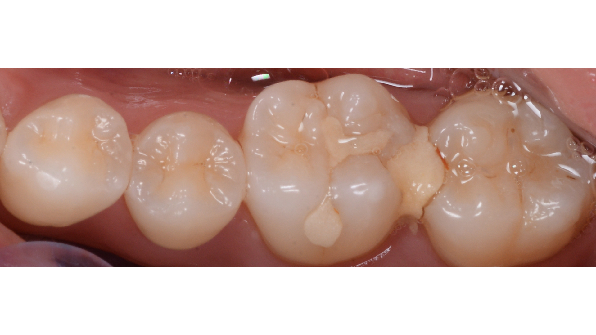 【担当医:荻原太郎】奥歯の虫歯治療　ダイレクトボンディング