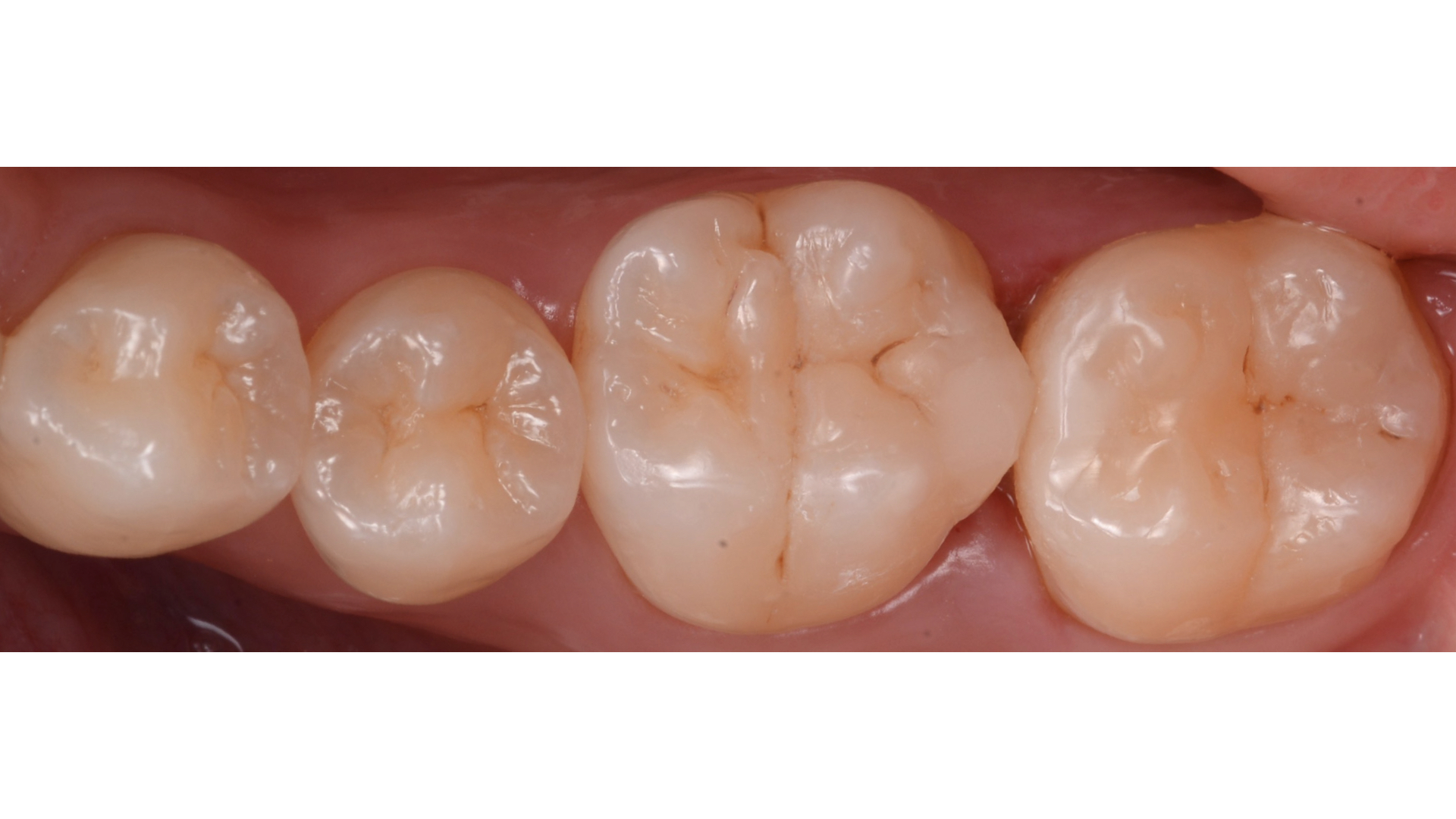 【担当医:荻原太郎】奥歯の虫歯治療　ダイレクトボンディング