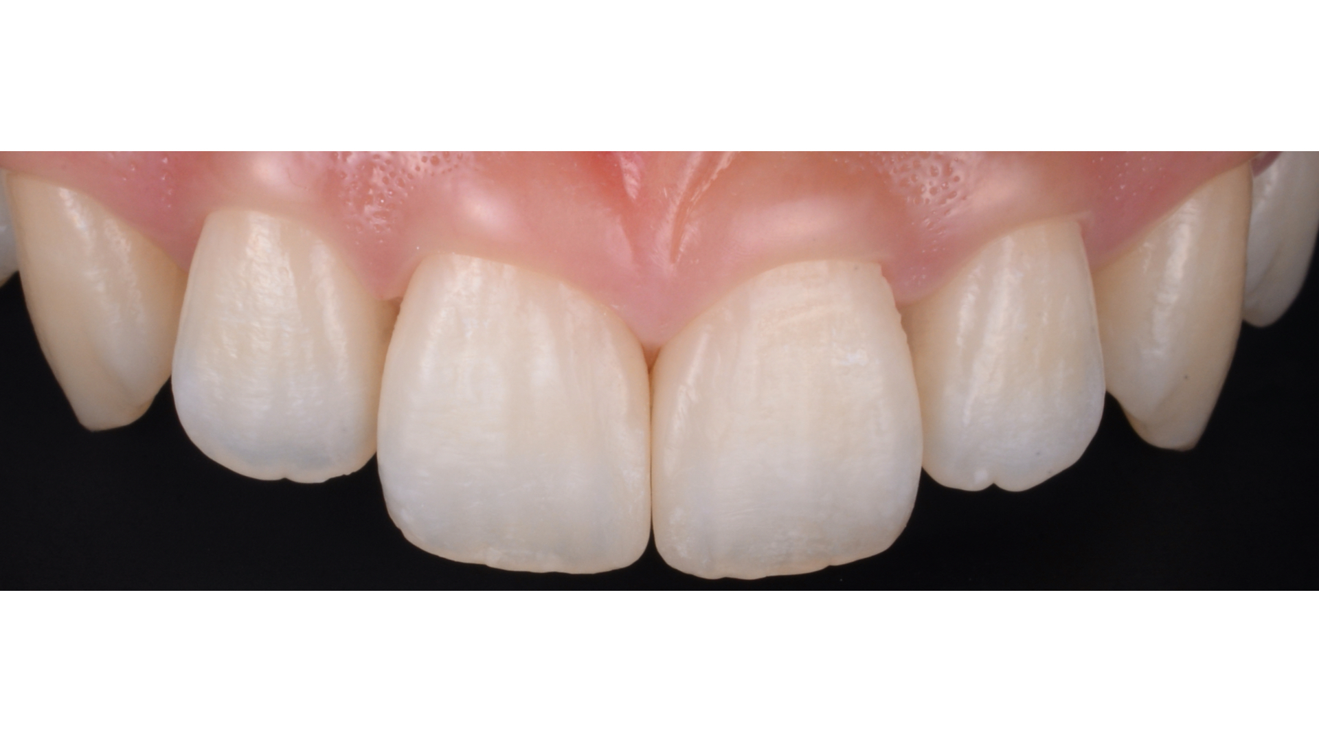 【担当医:荻原太郎】すきっ歯