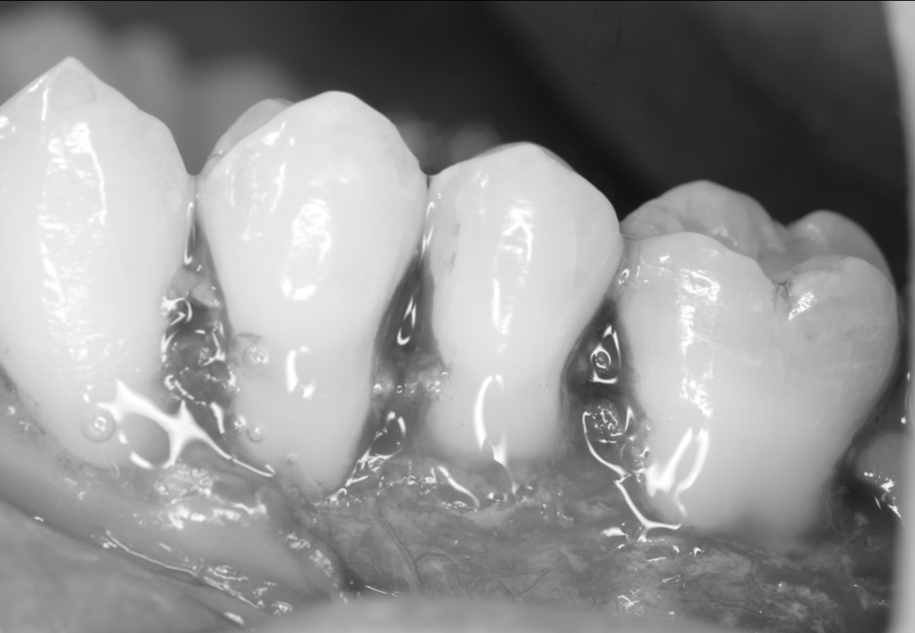 【池袋｜歯肉退縮の治療】結合組織移植術によるルートカバレッジで健康的で美しい歯ぐき