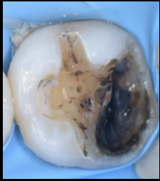 【池袋｜歯髄温存療法（VPT）】神経を残す最先端の虫歯治療｜グランドメゾンデンタルクリニック