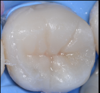 【池袋｜歯髄温存療法（VPT）】神経を残す最先端の虫歯治療｜グランドメゾンデンタルクリニック