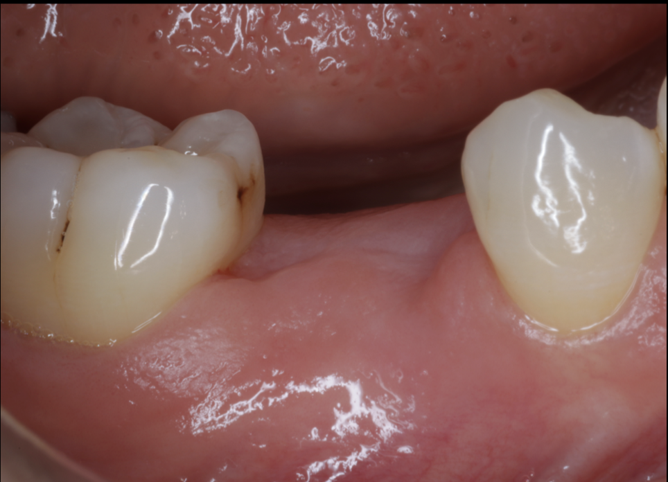インプラント治療に3〜4ヶ月も待てない方へ。池袋のグランドメゾンデンタルクリニックでは、ストローマンBLX導入により最短1ヶ月で仮歯装着も可能。即日インプラントにも対応。