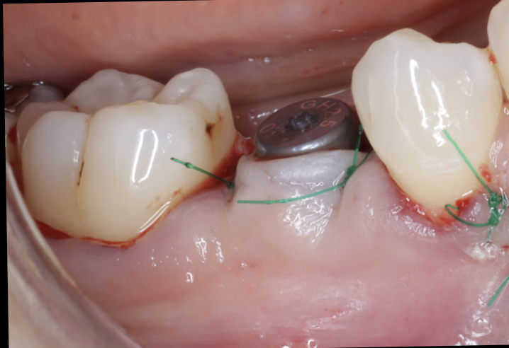 インプラント治療に3〜4ヶ月も待てない方へ。池袋のグランドメゾンデンタルクリニックでは、ストローマンBLX導入により最短1ヶ月で仮歯装着も可能。即日インプラントにも対応。