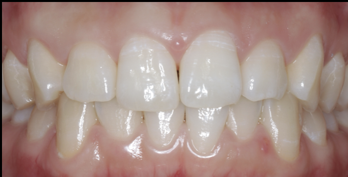 ホワイトニングのご紹介