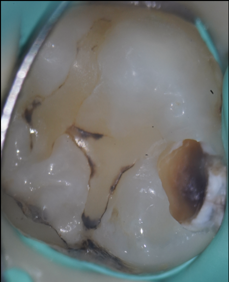 池袋で丁寧な虫歯治療を