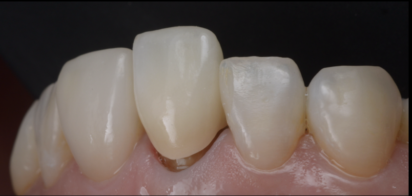 前歯1本のセラミック治療 ― シングルセントラルを自然に仕上げる当院のこだわり