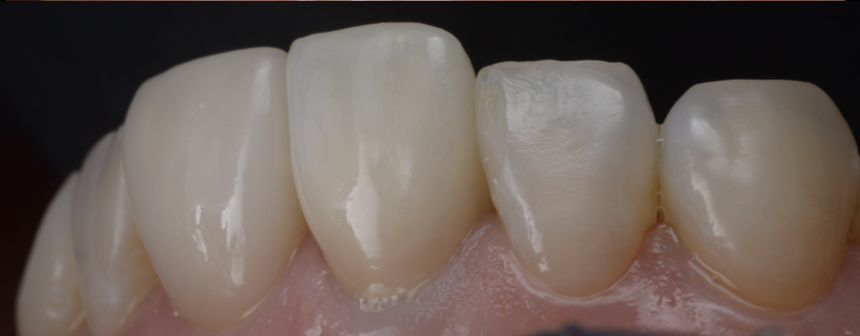 前歯1本のセラミック治療 ― シングルセントラルを自然に仕上げる当院のこだわり