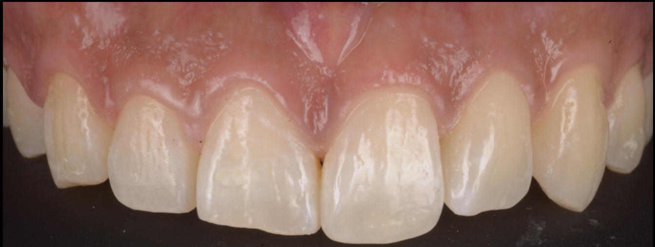 歯ぎしりで犬歯や前歯が削れてしまった方へ ― マウスピースだけではない包括的治療