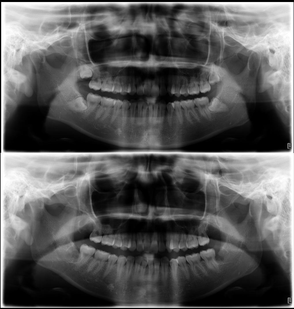 池袋で静脈内鎮静による親知らずの同日抜歯｜歯科恐怖症の方も安心して受けられる全埋伏智歯抜歯の症例