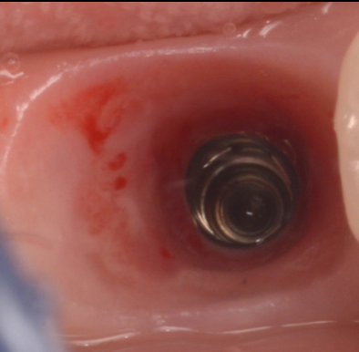 インプラントの長期予後を見据えた当院の取り組み