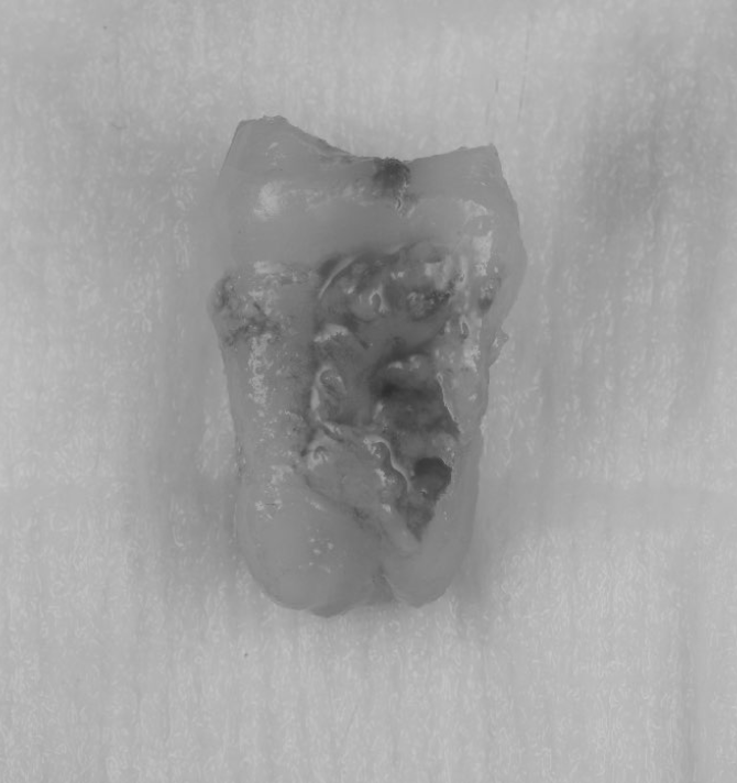 [池袋　歯医者]歯の移植〜インプラントをする前に歯を失った時のもう一つの選択肢として〜
