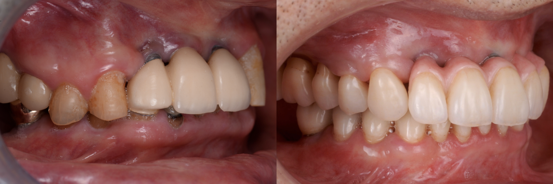 担当医　荻原太郎　すでに入っているインプラントと追加埋入および補綴治療で審美的機能的に回復させた症例