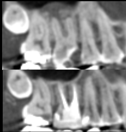 [池袋　歯医者]その歯、まだ残せるかもしれません