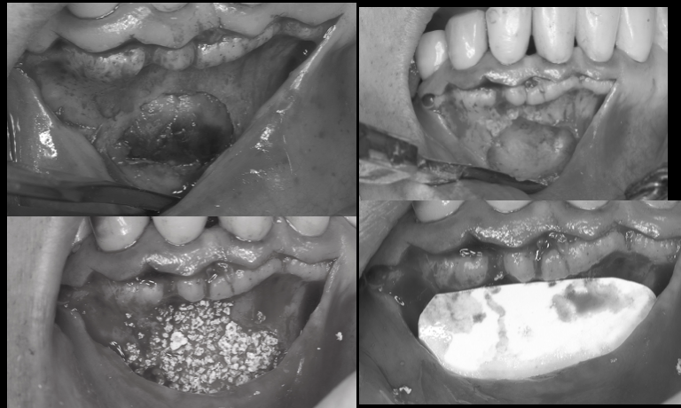 【池袋 歯医者】歯根嚢胞に対する歯根端切除術とは？〜抜歯を避けるための外科的歯内療