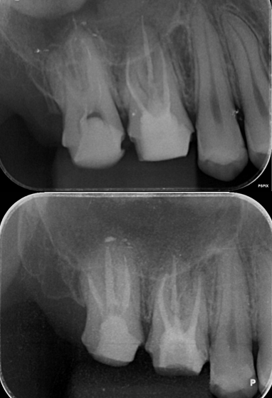 【池袋 歯医者】歯を抜かずに救う“最後の一手”──ATR-SITとは？