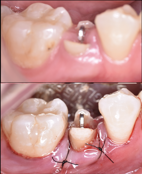 【池袋 歯医者】被せ物のトラブルを防ぐ！クラウンレングスニングとは？